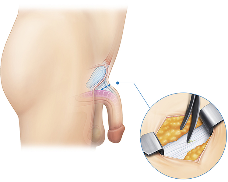 comprehensive penile enhancement in korea yezak urology in seoul