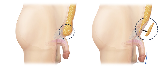 penis lengthening surgery in korea yezak urology clinic in seoul