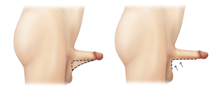 penis lengthening surgery in korea yezak urology clinic in seoul
