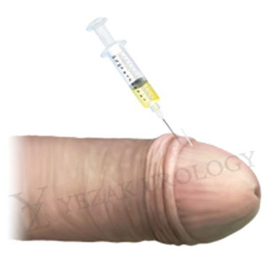 comprehensive penile enhancement in korea yezak urology in seoul