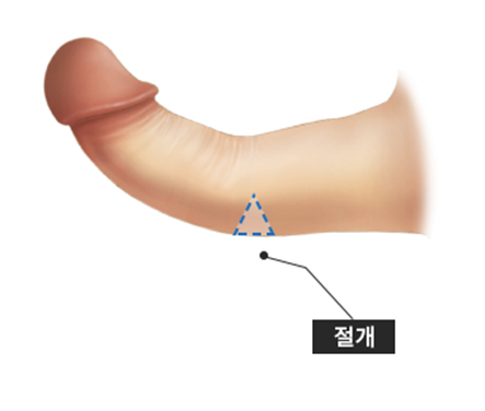 peyronie's disease treatment in korea yezak urology clinic in seoul