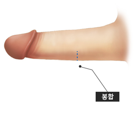peyronie's disease treatment in korea yezak urology clinic in seoul