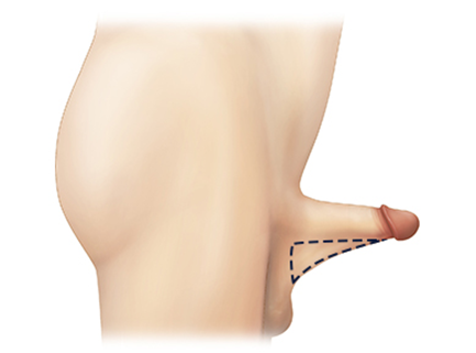 peyronie's disease treatment in korea yezak urology clinic in seoul