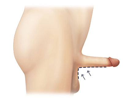 peyronie's disease treatment in korea yezak urology clinic in seoul