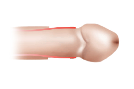 circumcision in korea yezak urology in seoul