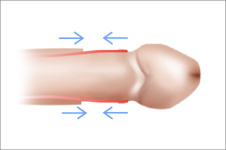 circumcision in korea yezak urology in seoul