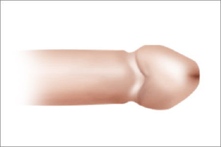 circumcision in korea yezak urology in seoul