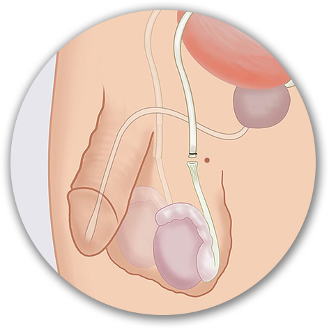 vasectomy in korea yezak urology in seoul