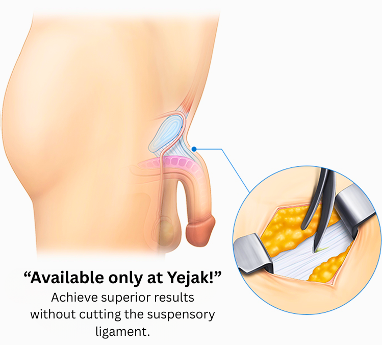penis lengthening surgery in korea yezak urology clinic in seoul