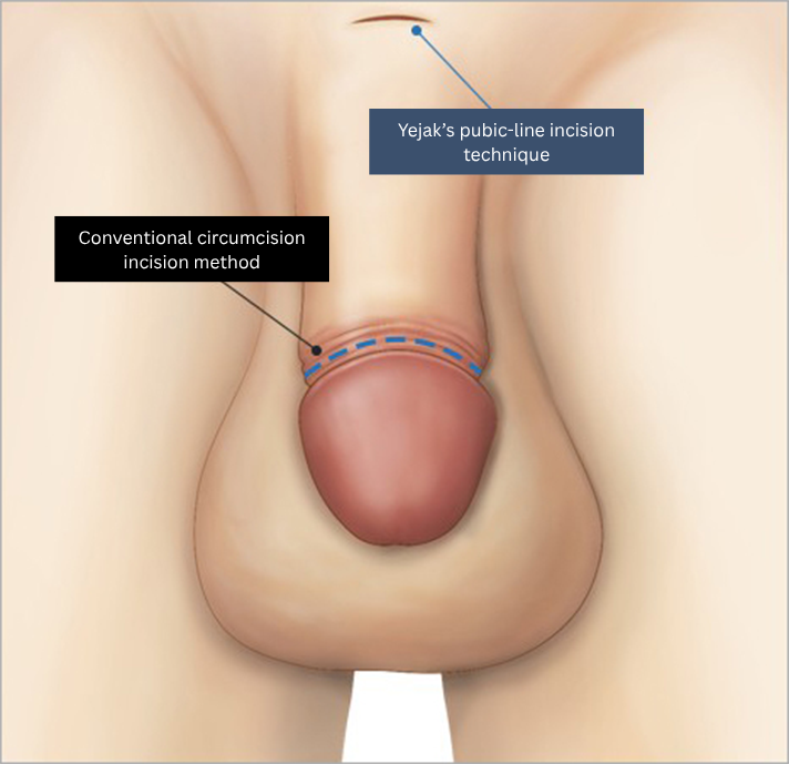 penis enlargement in korea yezak urology clinic in seoul