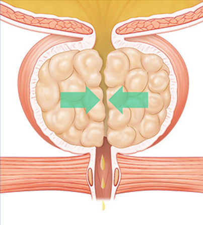 enlarged prostate treatment in korea yezak urology clinic in seoul