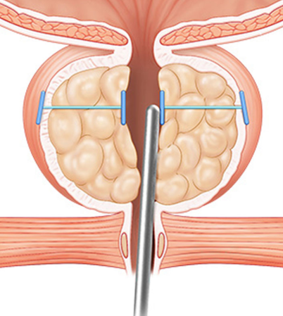 enlarged prostate treatment in korea yezak urology clinic in seoul