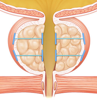 enlarged prostate treatment in korea yezak urology clinic in seoul