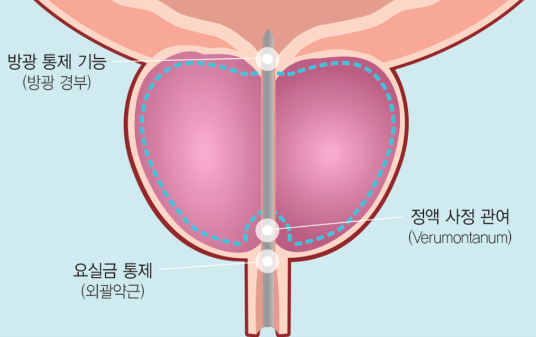 enlarged prostate treatment in korea yezak urology clinic in seoul