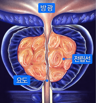 enlarged prostate treatment in korea yezak urology clinic in seoul