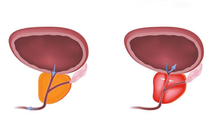 prostatitis treatment in korea yezak urology clinic in seoul