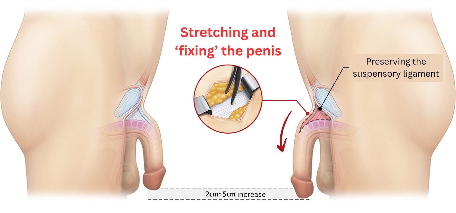 penis lengthening surgery in korea yezak urology clinic in seoul