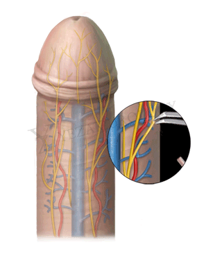 premature ejaculation treatment in korea yezak urology clinic in seoul
