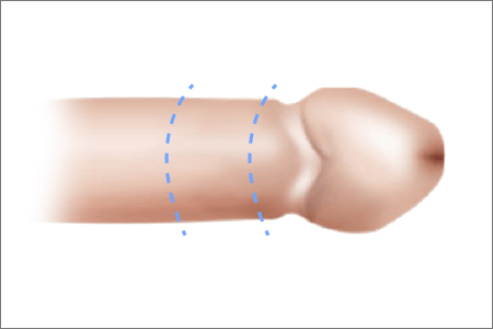 circumcision in korea yezak urology in seoul