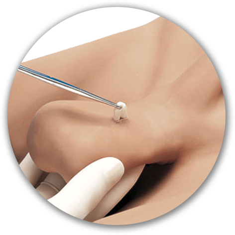 vasectomy in korea yezak urology in seoul