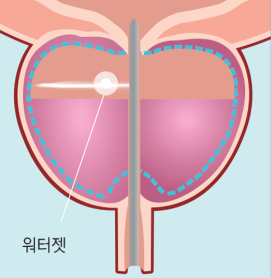 enlarged prostate treatment in korea yezak urology clinic in seoul